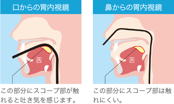 経口内視鏡・経鼻内視鏡検査